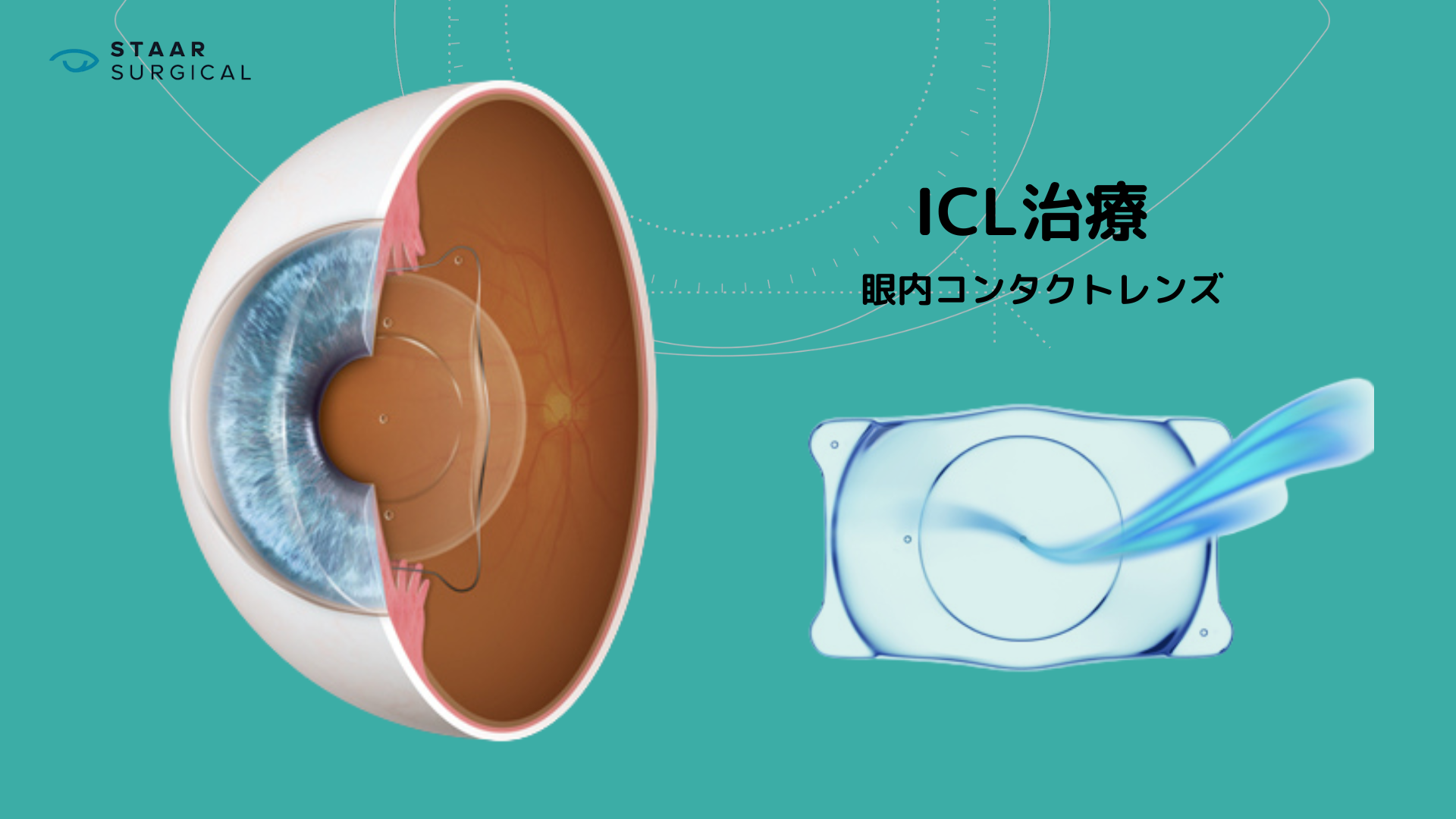 ICLの見え方