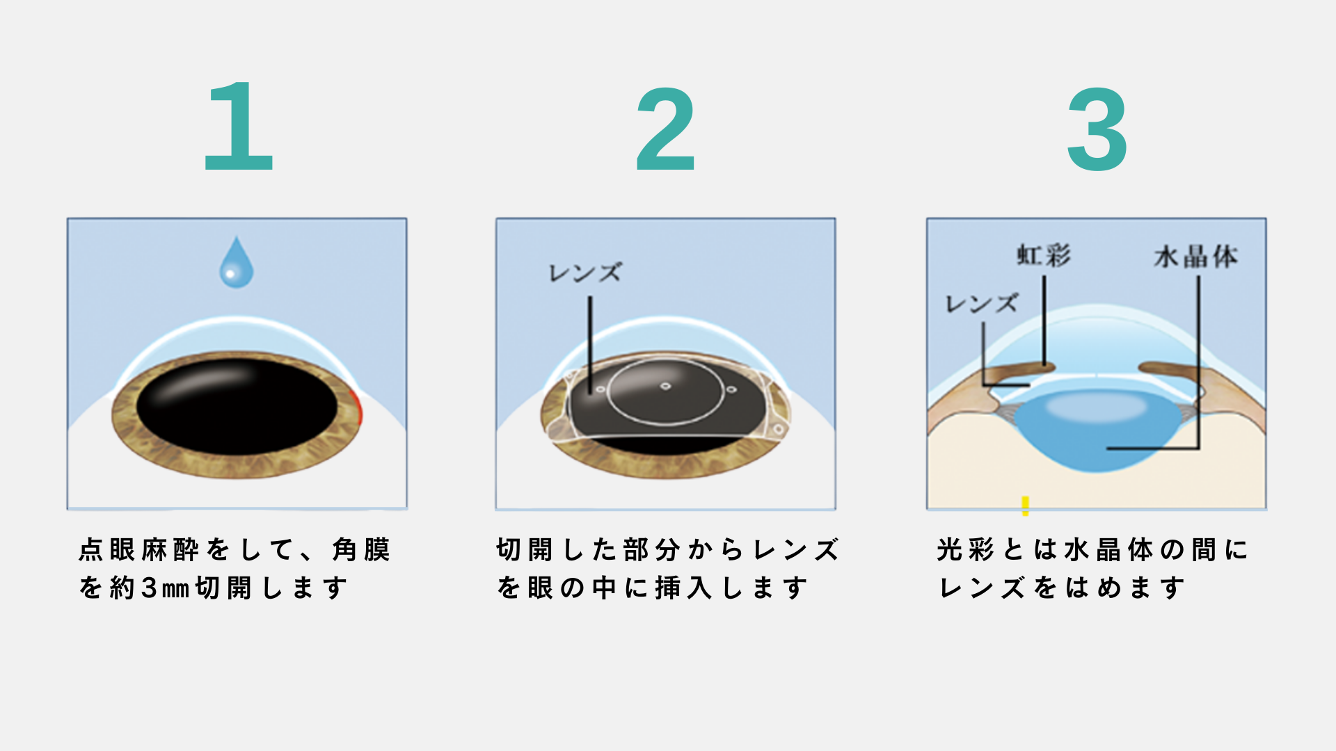 眠っている間に視力矯正　オルソケラトロジー