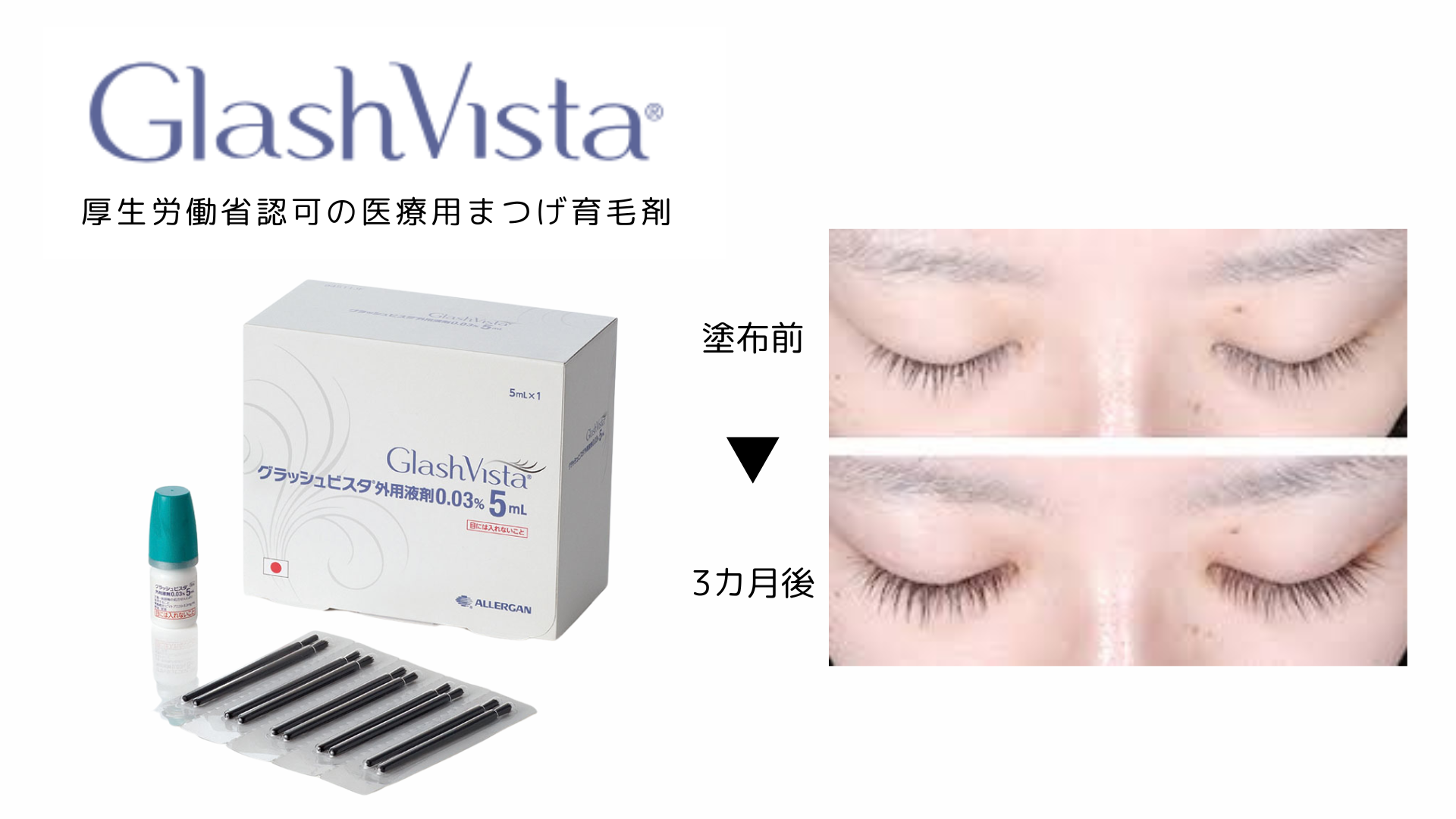 「グラッシュビスタ®」は承認を受けた唯一の睫毛貧毛症治療薬