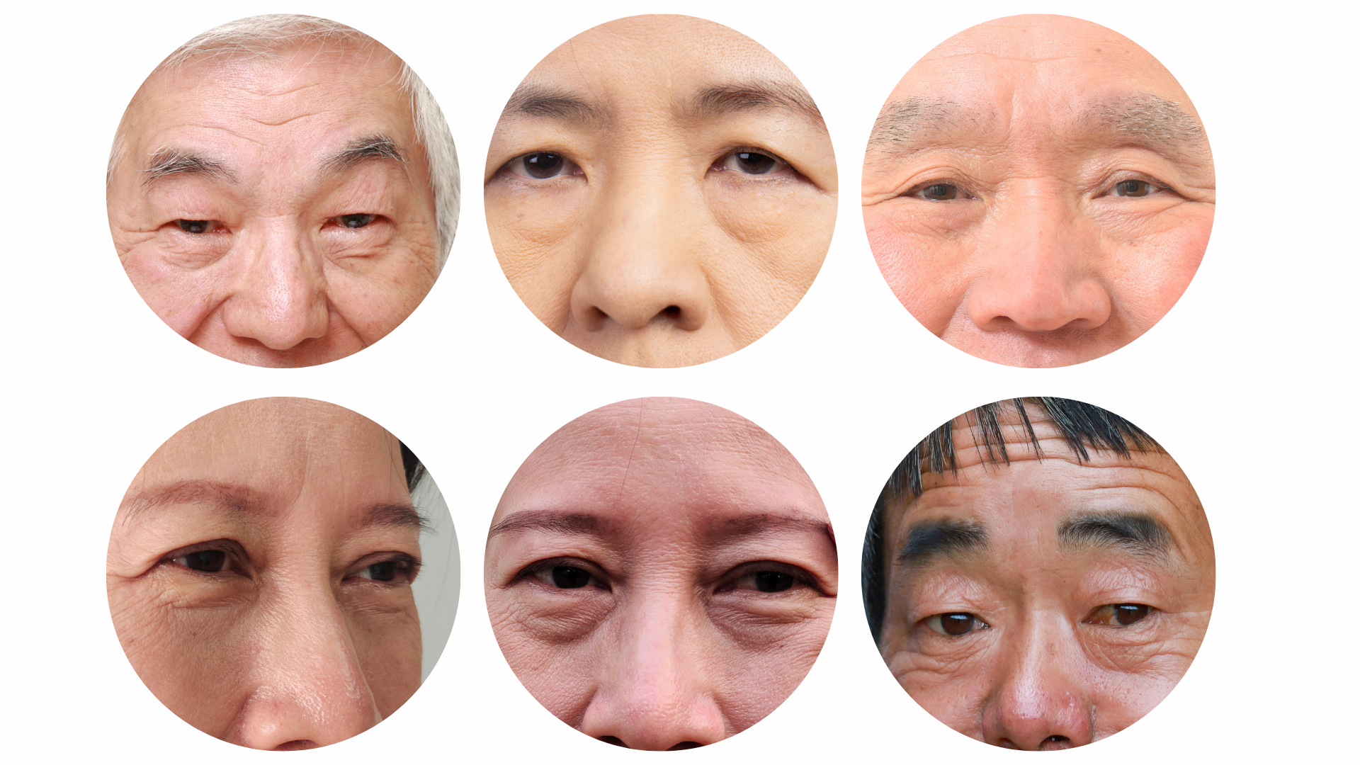 眼瞼下垂症の原因