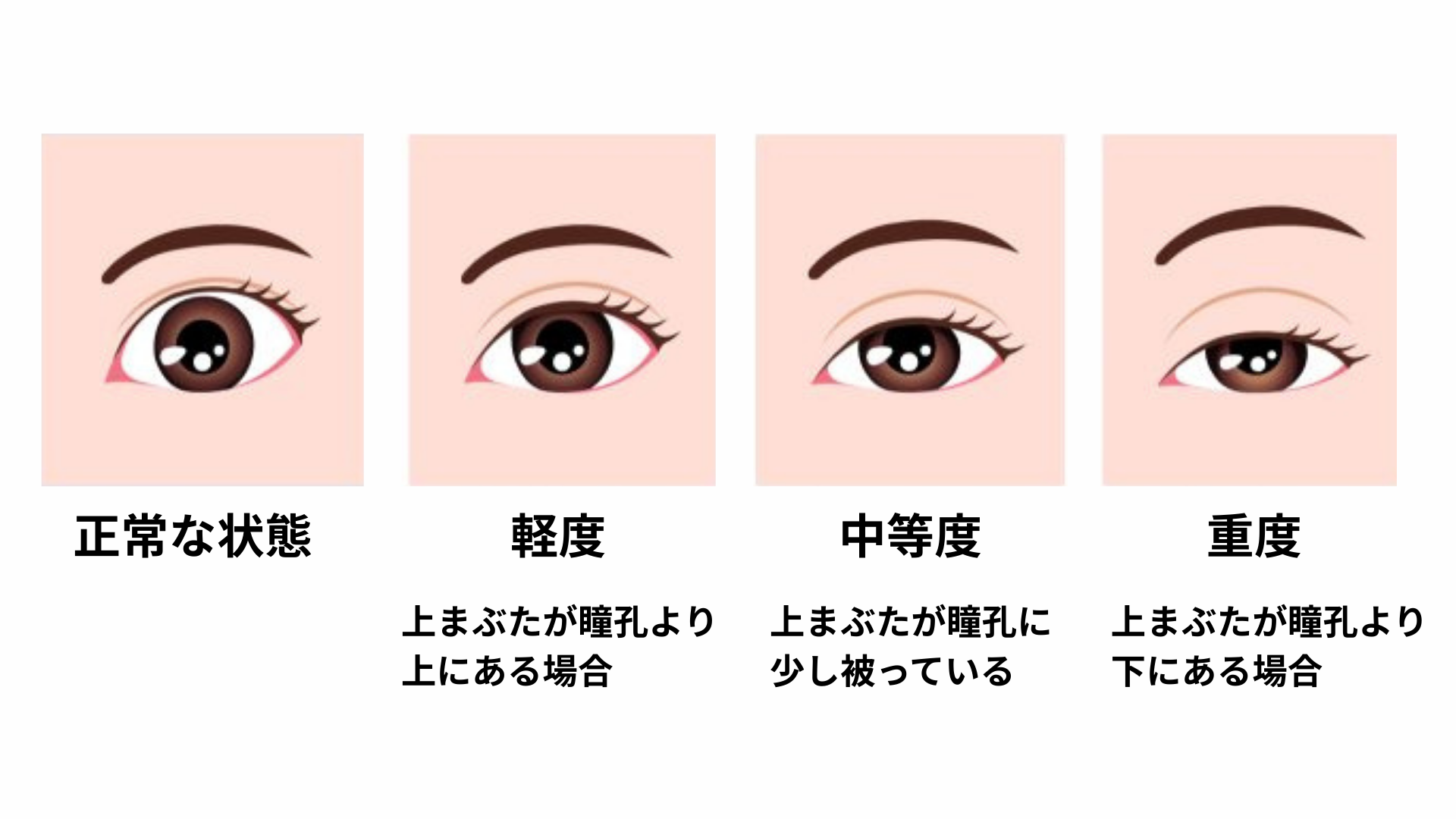 眼瞼下垂症の原因