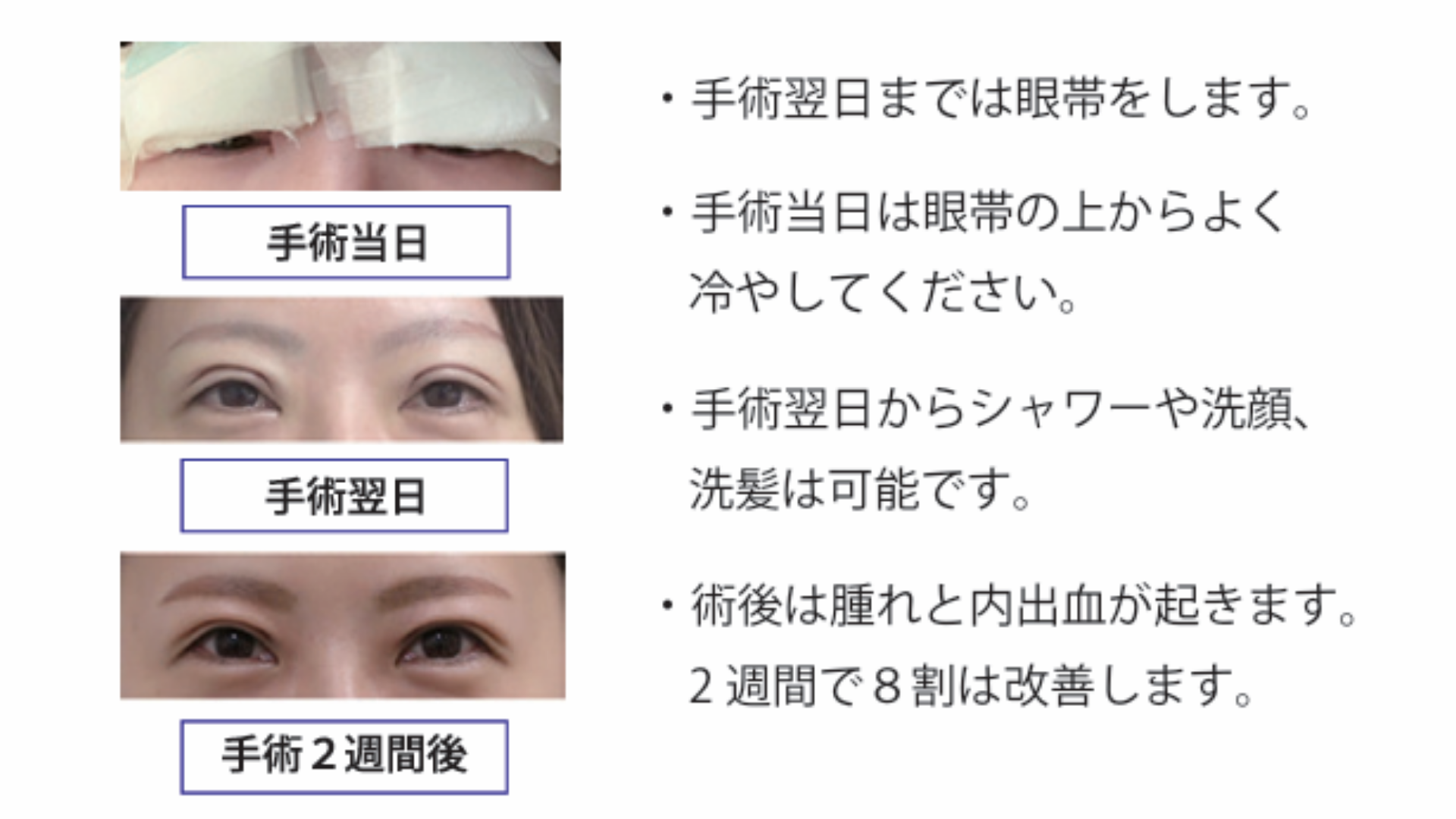 眼瞼下垂症の原因