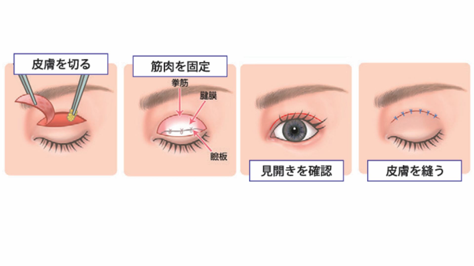 眼瞼下垂症の原因